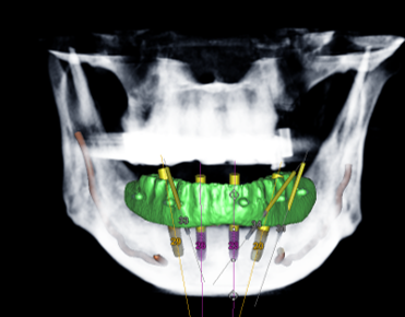 An extra of the jaw and teeth of a patient with proposed prosthodontics work included