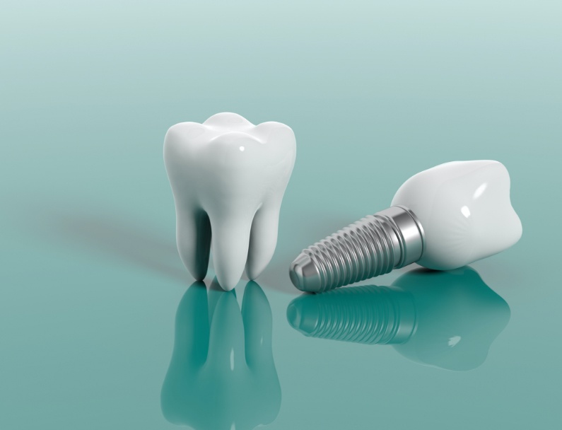Tooth vs. Implant