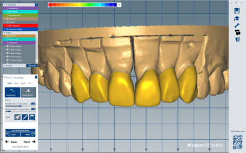 Computer rendering of teeth and implants for proposed prothodontics work