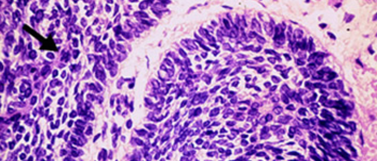 Hi mag tumor cells